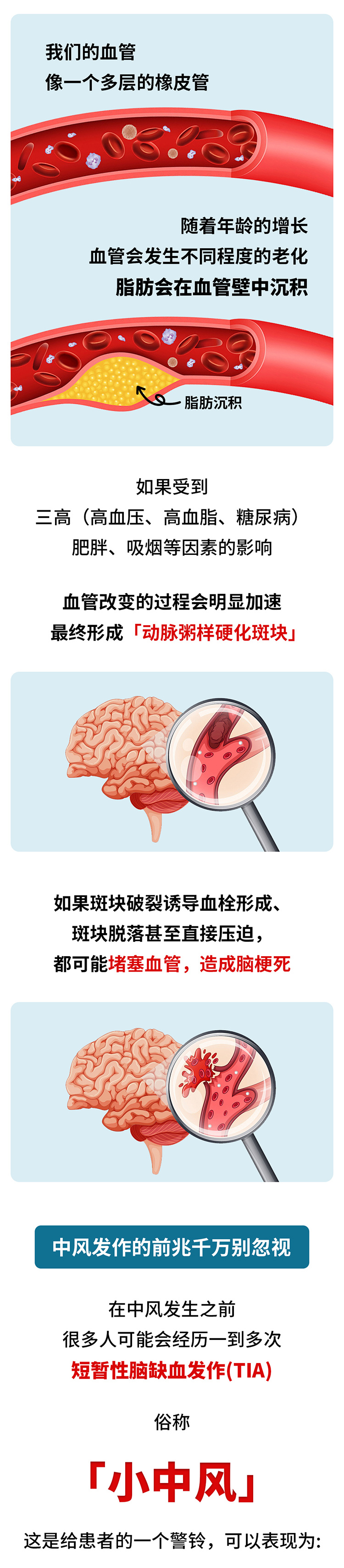 中風(fēng)的5個(gè)前兆，盡早發(fā)現(xiàn)能救命_02.jpg